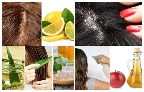 Como Eliminar La Caspa Del Cabello De Forma Natural