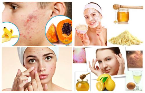 remedios caseros para el acne hormonal