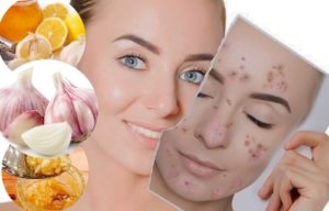 beneficios del ajo para el acné