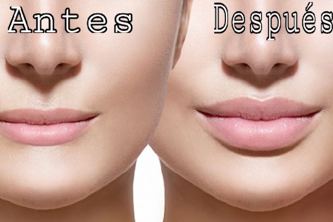 acido hialuronico en los labios antes y despues